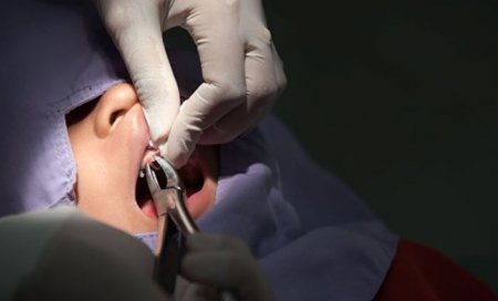 Ученые обнаружили способ восстанавливать зубную эмаль